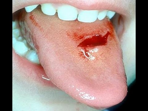 management of tongue lacerations