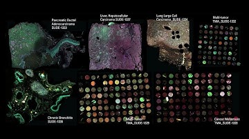 Capturing the Spatial Landscape of Tumor and Immune Cell Lineages in the Cancer TME