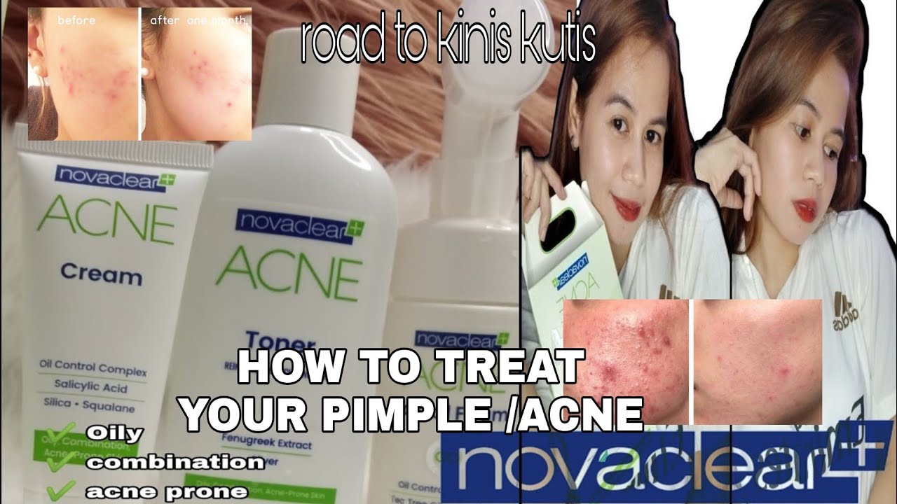 novaclear acne cream