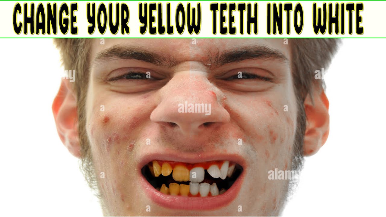 The BEST Way to Whiten Teeth in saira tech tip YouTube