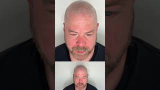 Scalp micropigmentation in Austin, Texas best hairloss solution