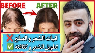 رشها علي شعرك 7️⃣ ايام و سيتحول شعرك الي كثيف مثل البروكة | تطويل و تكثيف ✅ صلع و انبات الشعر ❌