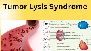 Tumor Lysis Syndrome: Early Recognition and Evidence-Based Management | ICU & Internal Medicine