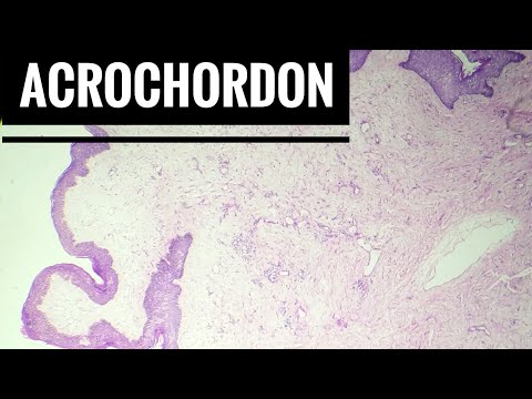 Fibro epithelial Polyp / Acrochordon