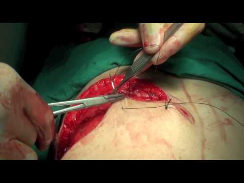 Operation 8 (Part 2) - Simple Mastectomy and Expander