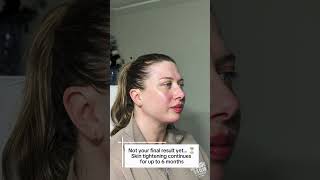 Submental liposuction healed results! #submentalliposuction #beforeandafter