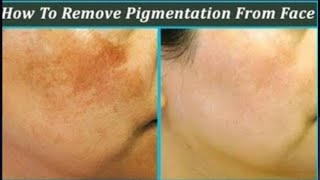How To Remove Pigmentation Frackel Dark Sports Melasma With Parley Nomarks Anti Marks Cream