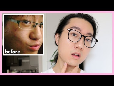 How I Get Rid of Acne Scars (clear skincare routine + diet, exercise)