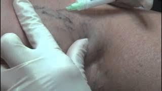 Sclerotherapy video - VSCF