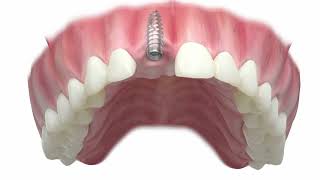 Zahn-Implantate - nicht für jeden geeignet