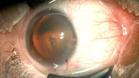 PHACO STUDIES (Pulsed US mode 10): Little maneuver for runout capsulorhexis