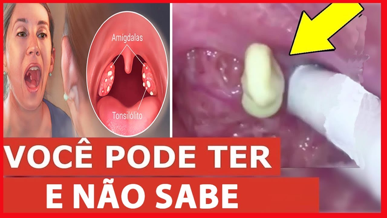 Como Fazer O Comprimido Descer Da Garganta