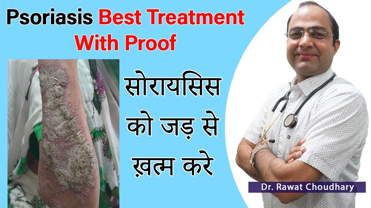 how to cure psoriasis permanently in hindi psoriasin shampoo review