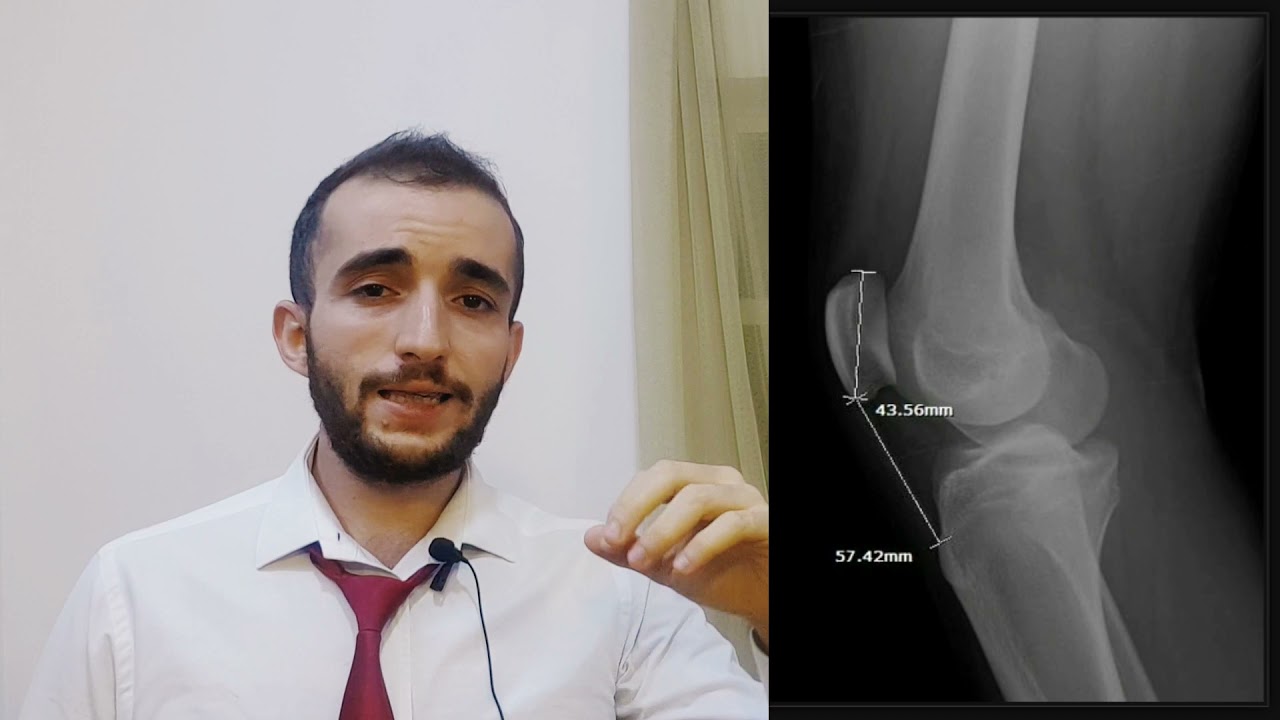 LL: Patellar fracture l كسر عظم الرضفة