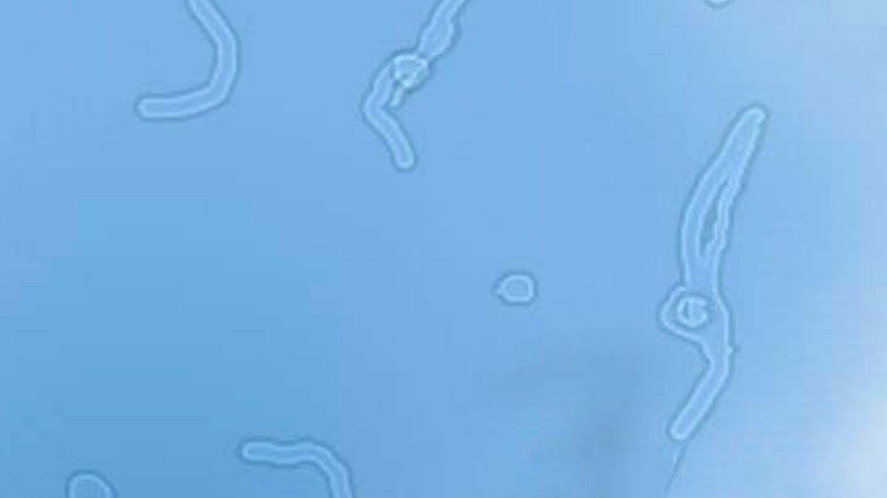 Почему мелькают МУШКИ перед глазами? / НА ЗДОРОВЬЕ - YouTube