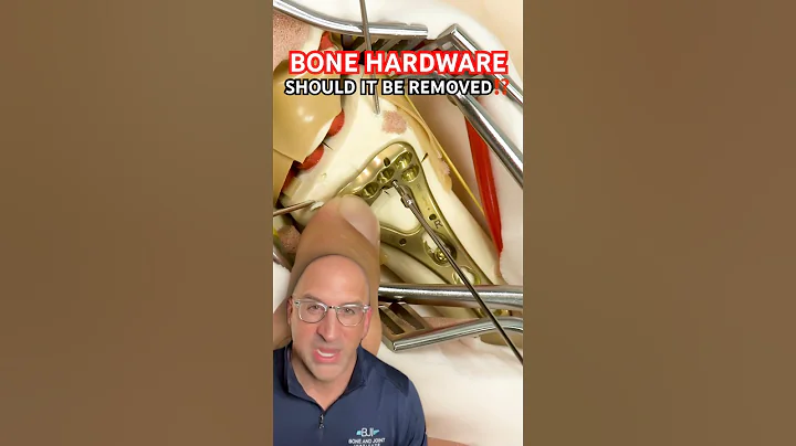 Should Bone Plates & Screws Be Removed⁉️ #shorts