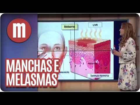 tipos de melasma