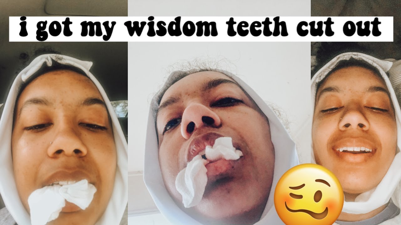 I GOT MY WISDOM TEETH CUT OUT YouTube