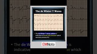 De Winter T Wave (STEMI Equivalent)