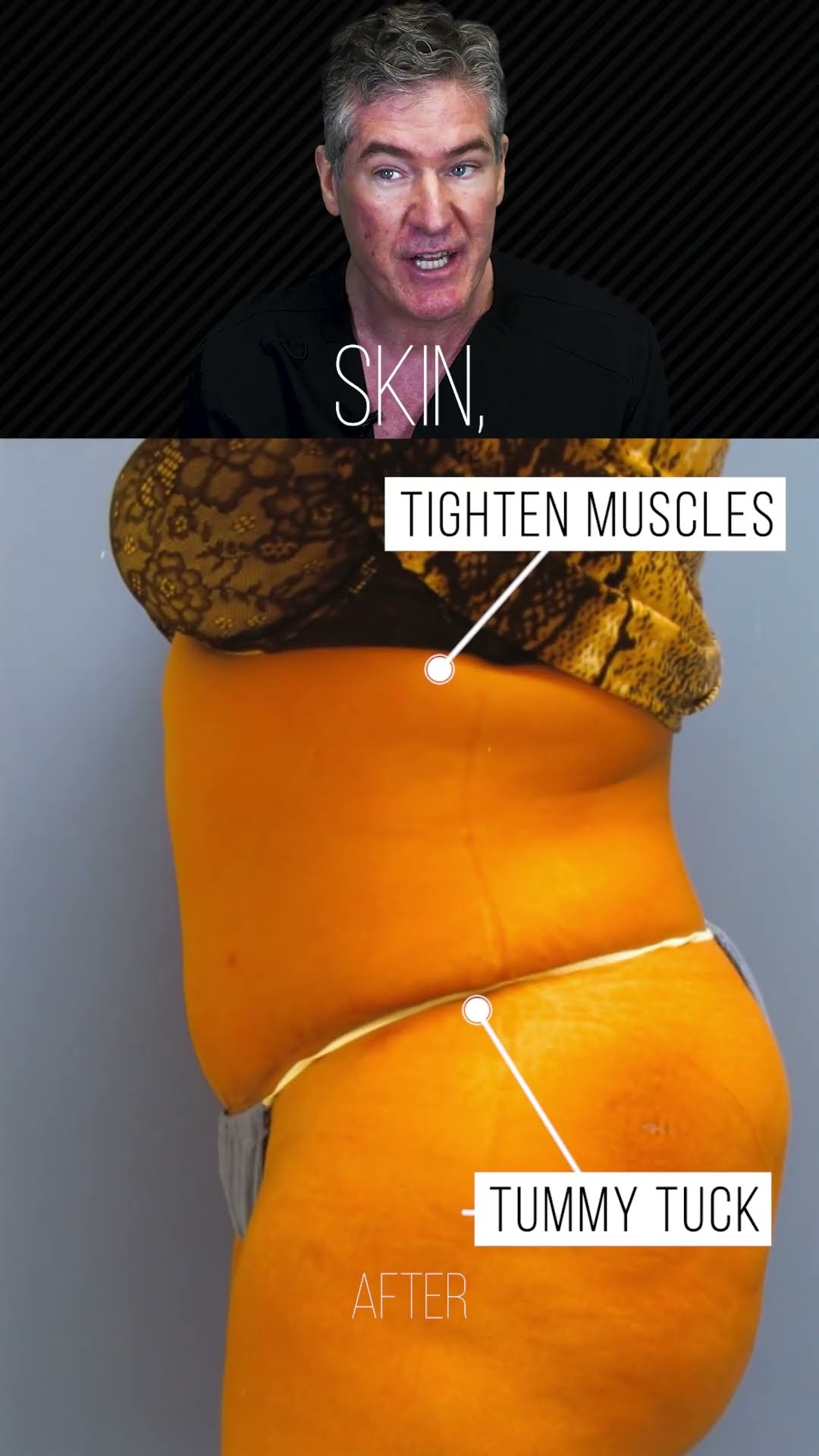 Tummy tuck, four months out