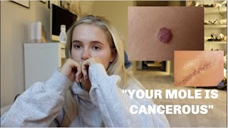 I FOUND OUT MY MOLE WAS CANCEROUS | WHAT