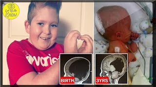 Boy Born With 2% Brain Grows The Rest On His Own