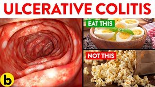 Foods You Should And Should Not Eat With Ulcerative Colitis screenshot 5