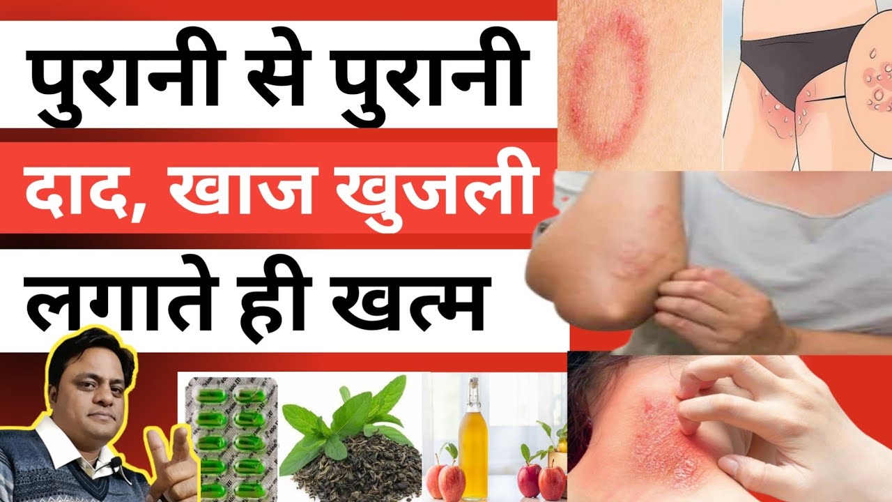 शरीर मे खुजली का आसान इलाज। Body Ittiching Solution। Sharir Me Bhot