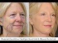 Ponytail facelift before and after  the future of plastic surgery