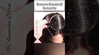 Remove Dandruff Instantly 😱💯 /Get Rid Of Dandruff #shorts #haircare #dandruff #viral #youtubeshorts