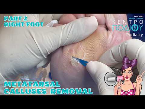 2.Metatarsal Calluses RemovalΚάλοι & Σκληρύνσεις #kentropodiou #κεντροποδιου #podologia #podiatrist