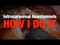 Robotic Ileocolic Intracorporeal Anastomosis, My Preferred Method