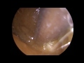 273 - Ear Wax Removal Difficult Case with Ear Wax Stuck in Anterior Recess near Eardrum