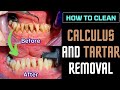 DENTAL CALCULUS and TARTAR removal - TARTRECTOMY before and after DENTAL CLEANING