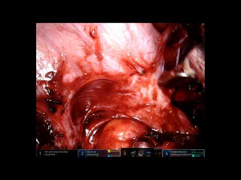 Robotic Sigmoid Colectomy for Complicated Diverticulitis   Fistula to left tube