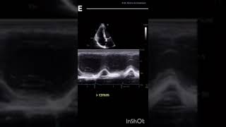 Tapse Measurement In Echocardiography- Made Simplified