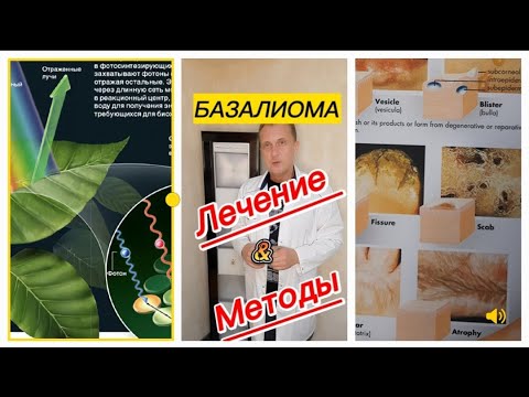 Базалиома. Базальноклеточный рак кожи.