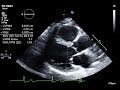 Routine Echocardiogram Protocol With Standard 2D Echo Images and Color Doppler