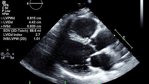 Routine Echocardiogram Protocol With Standard 2D Echo Images and Color Doppler