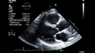 Routine Echocardiogram Protocol With Standard 2D Echo Images and Color Doppler