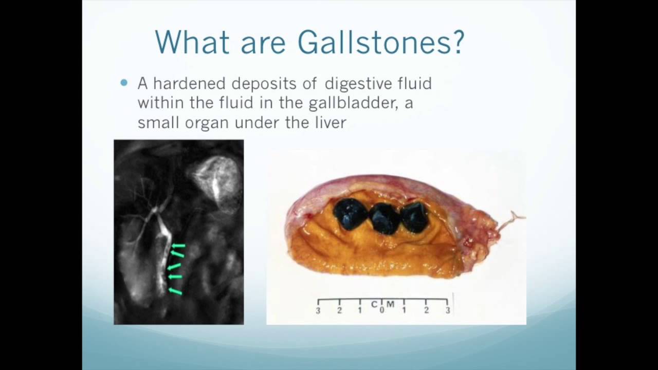 Gallstones 