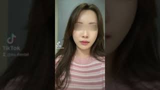 Korean V-Line Surgery + Zygoma Reduction Surgery Results | (Before & After)