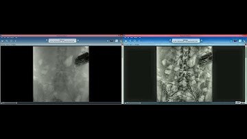 ProHawk AI Detailed Angiogram Imaging | Medical Devices