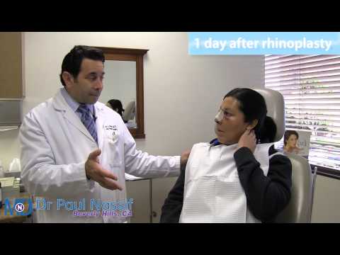 Rhinoplasty 1 Day