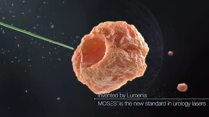 Lumenis Moses Technology