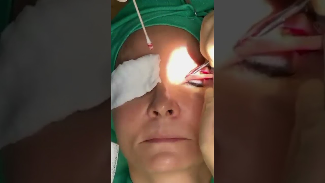 Cautery: Minimizing Bleeding During Surgical Procedures