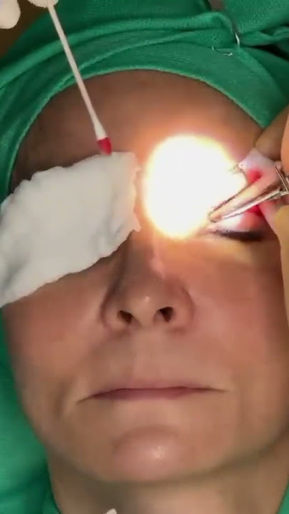 Cautery: Minimizing Bleeding During Surgical Procedures