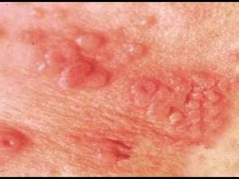 Get Rid Of A Yeast Infection Naturally Fast Get Rid Of A Yeast Infection Naturally Fast