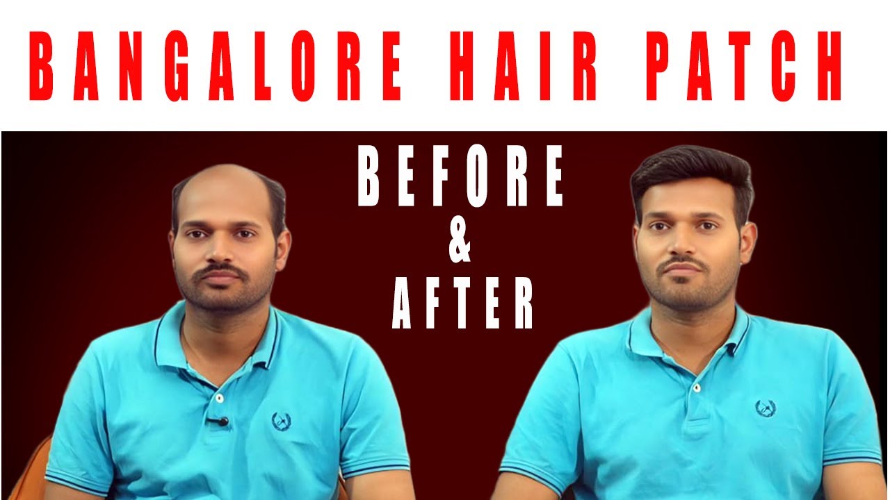 Лучшая безоперационная процедура восстановления волос в Бангалоре | Шокирующие результаты!