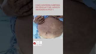 Un caso de leucemia/linfoma T del adulto, HTLV-1